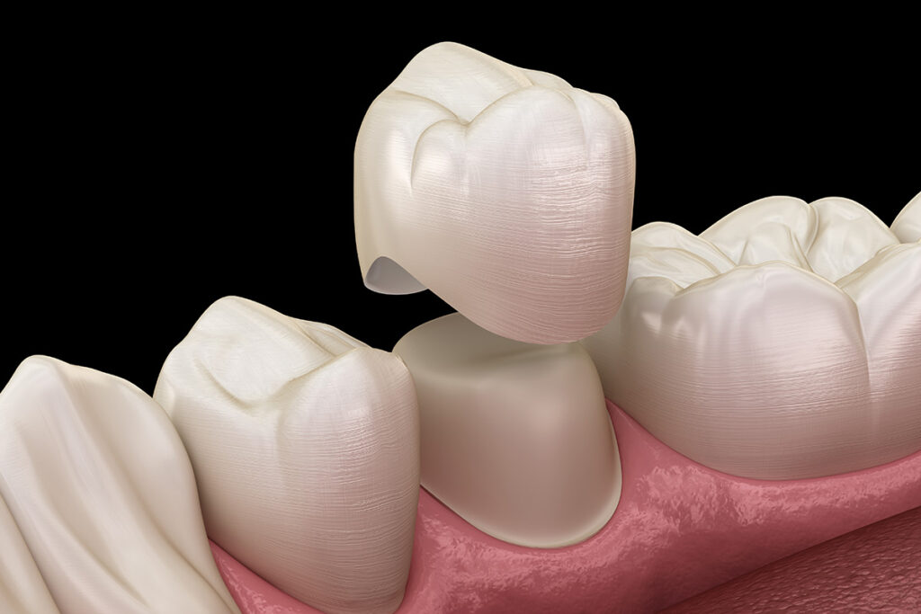Custom dental crown diagram.