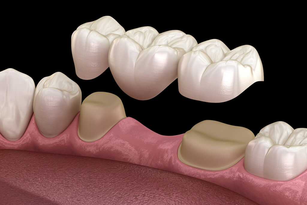 Diagram of dental bridges.