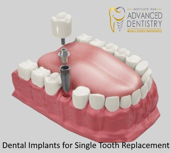 Benefits of Dental Implants for Single Tooth Replacement