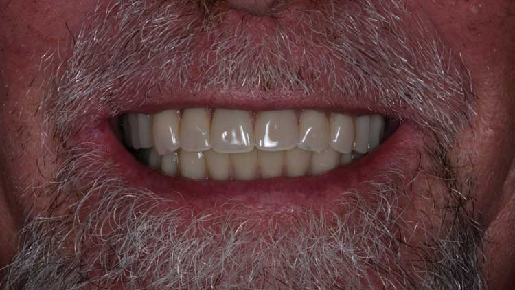 Full-Mouth Implant Makeovers, after