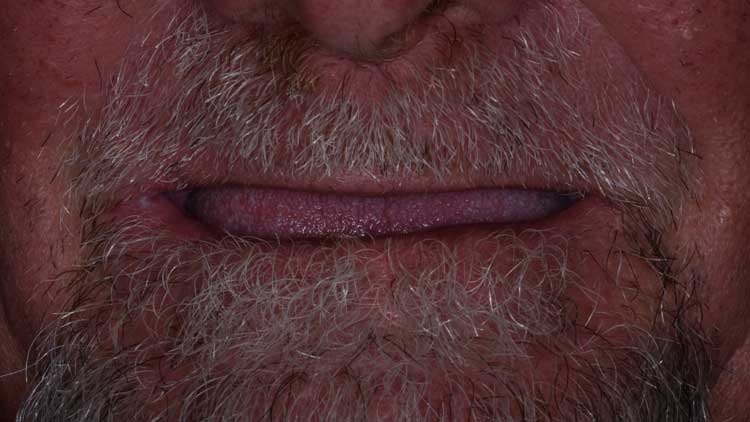 Full-Mouth Implant Makeovers, before