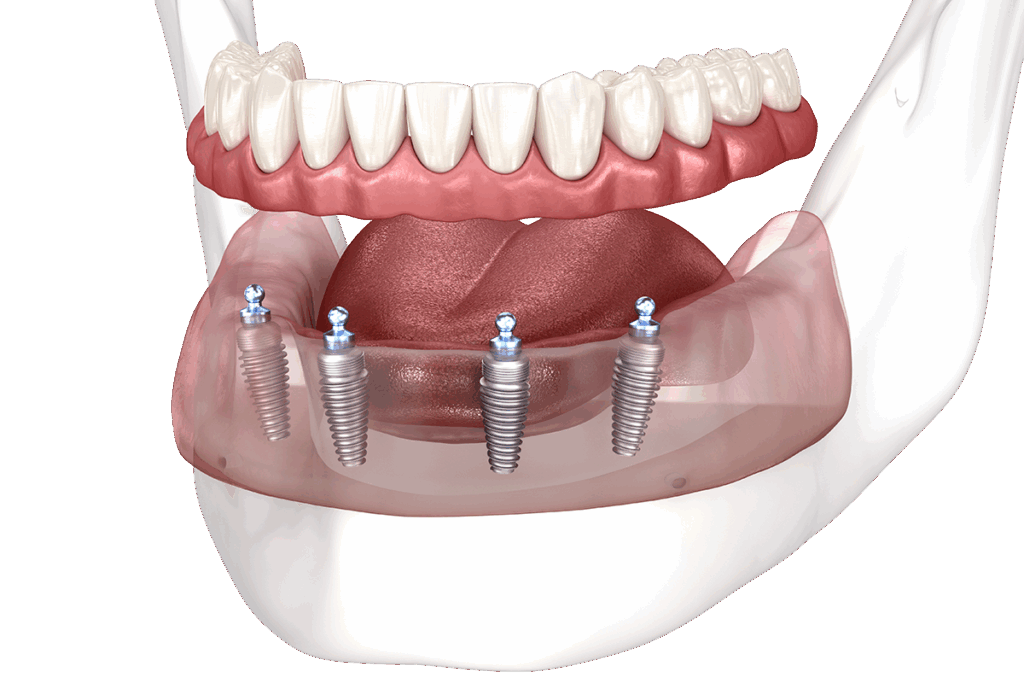 Diagram of New Teeth in One Day dental implants.