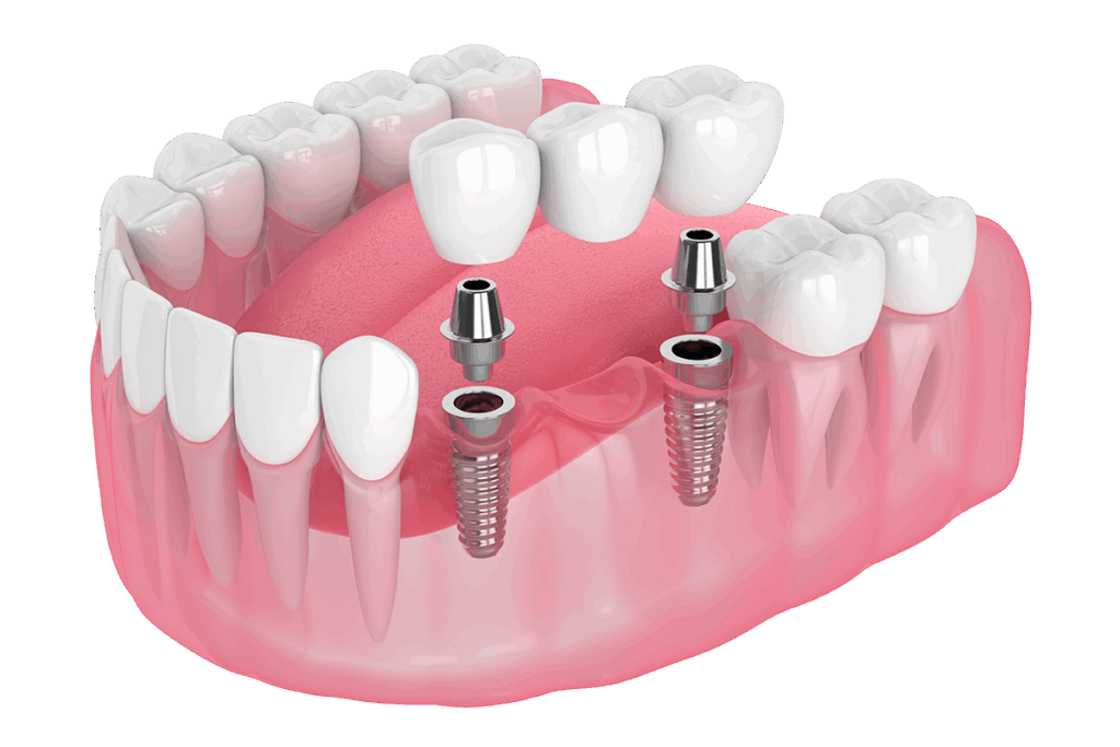 Diagram of several adjecent dental implants.