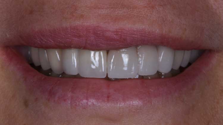 Single Implants, after