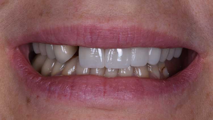 Single Implants, before