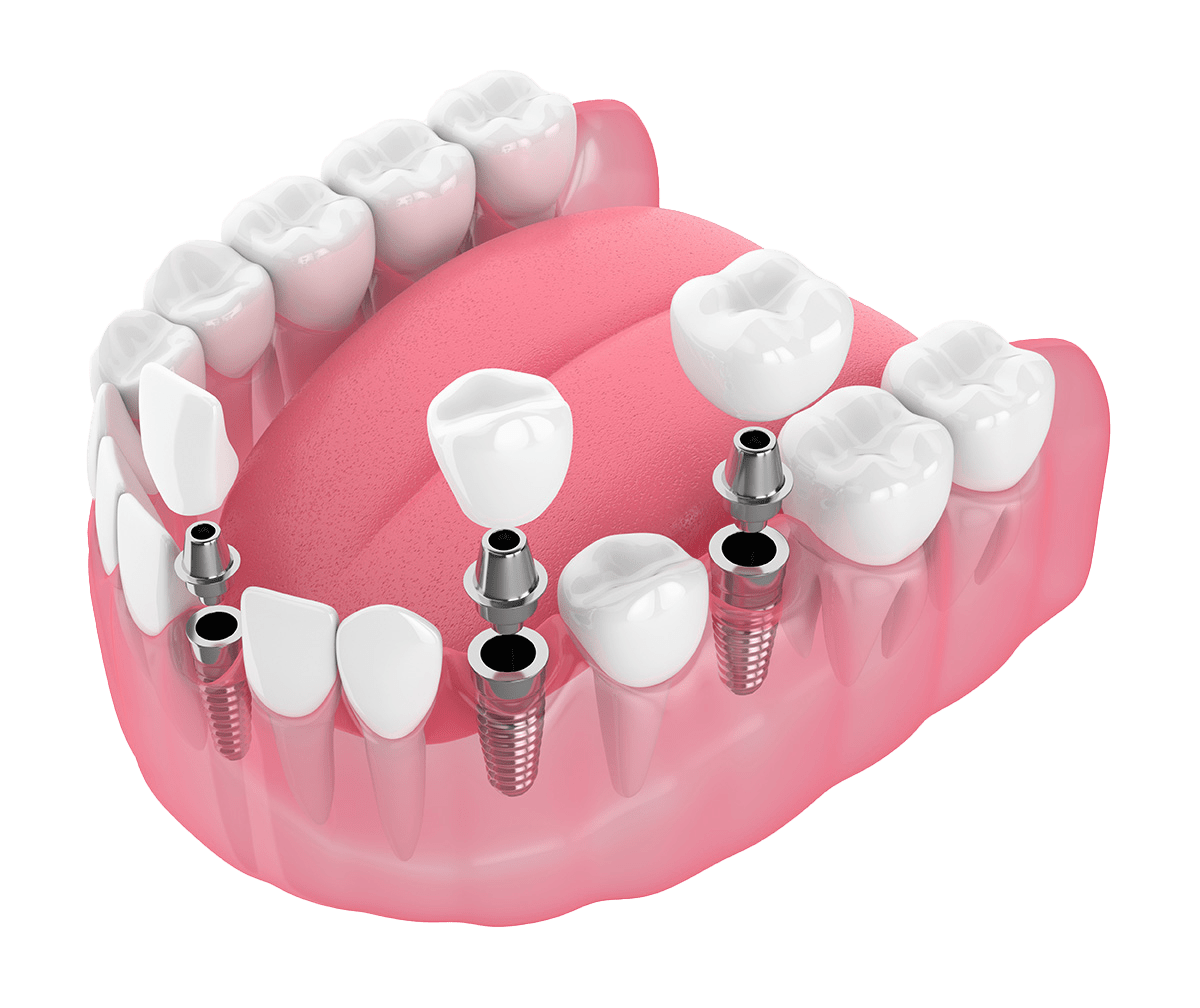 Diagram of single tooth dental implants.