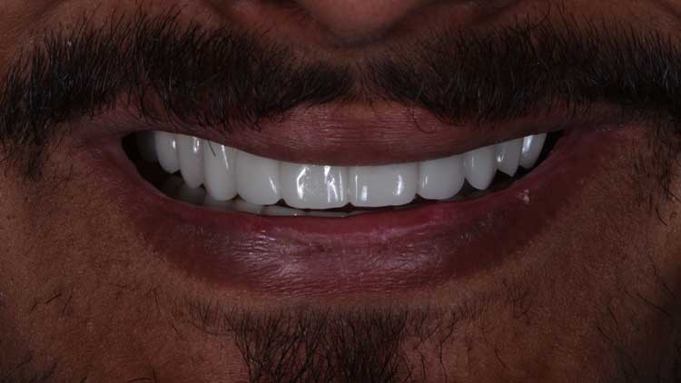 Smile Makeover, after