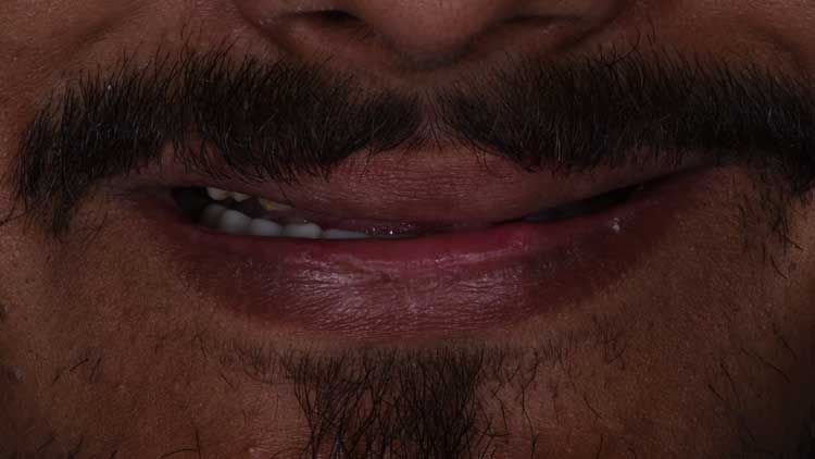 Smile Makeover, before