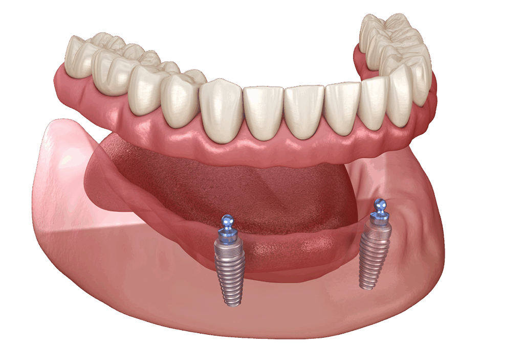 Diagram of using dental implants for snap on dentures.