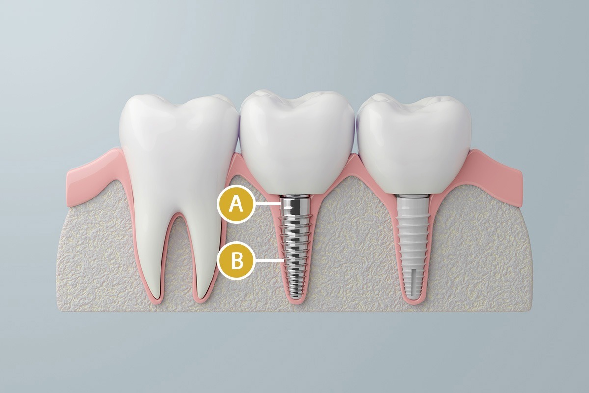 Diagram showing latest dental implants.